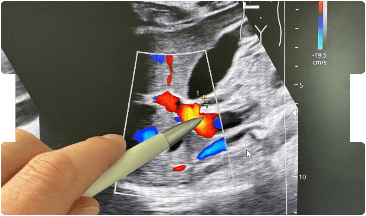 A clinician points to a Doppler ultrasound image showing blood flow near the gallbladder, highlighting anatomy and surgical precision in laparoscopic cholecystectomy.