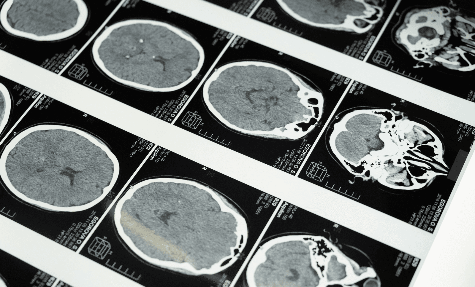 Brain-scan-tumour-acoustic-neuroma