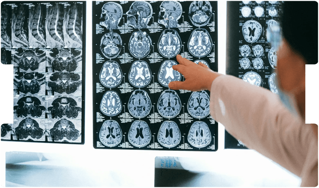 Doctor reviewing multiple brain MRI scans, illustrating the diagnostic complexity and medico-legal challenges of brain tumour cases.