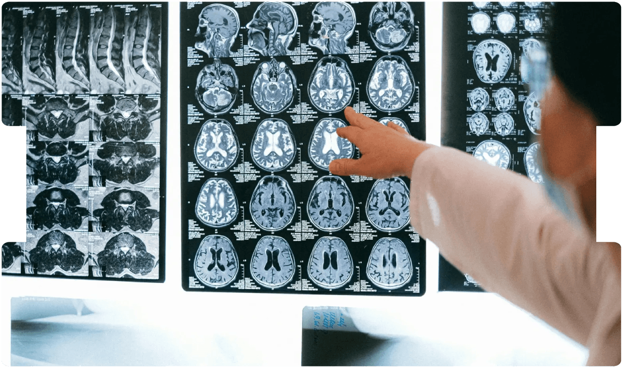 Doctor reviewing multiple brain MRI scans, illustrating the diagnostic complexity and medico-legal challenges of brain tumour cases.