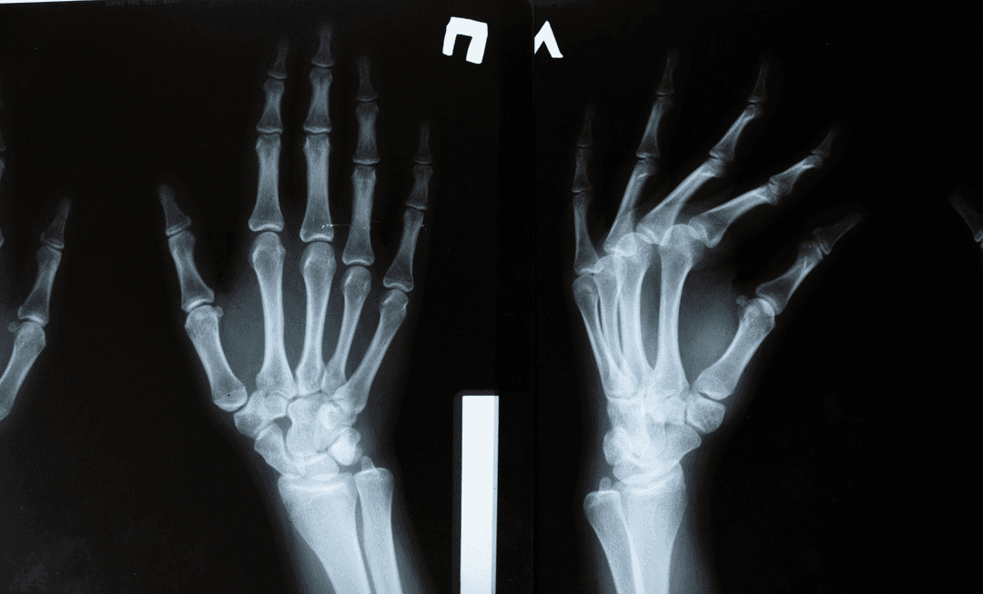X-ray images of fractured hands, illustrating diagnostic challenges and medico-legal insights gained from nine years of missed fracture cases.