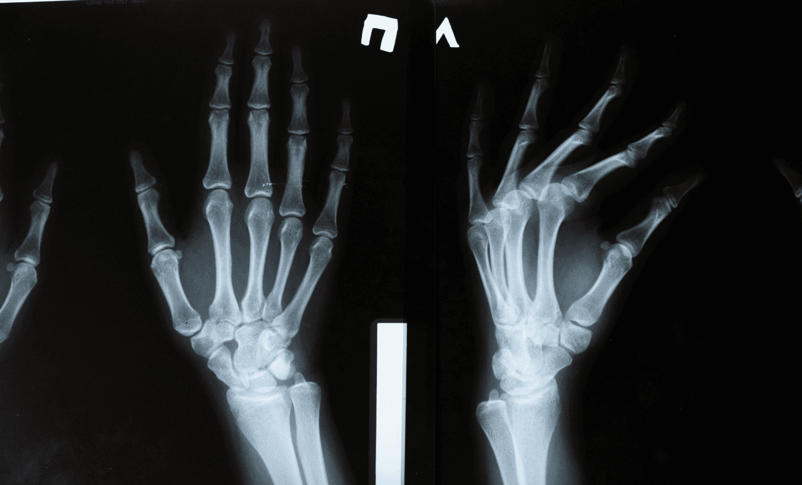 hands-bone-xray-missed-fracture-INNEG