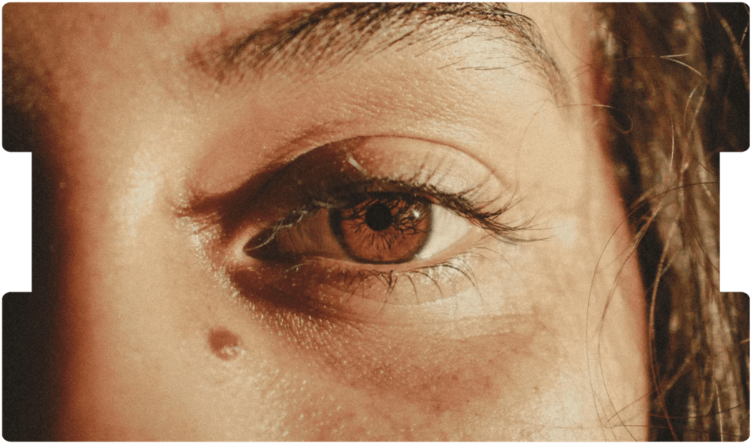 Close-up of a person’s eye and surrounding skin, illustrating vigilance in recognising melanoma signs and addressing related litigation issues.