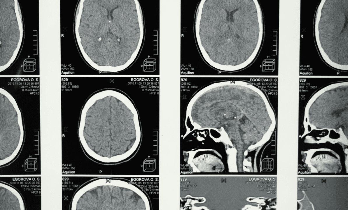 brain-scan-neuro-injury