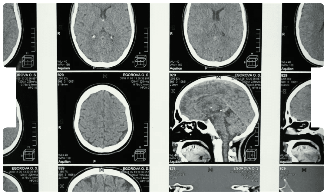 Brain CT scans displayed for analysis, highlighting the diagnostic and medico-legal complexities of distinguishing genuine neurological symptoms from malingering.