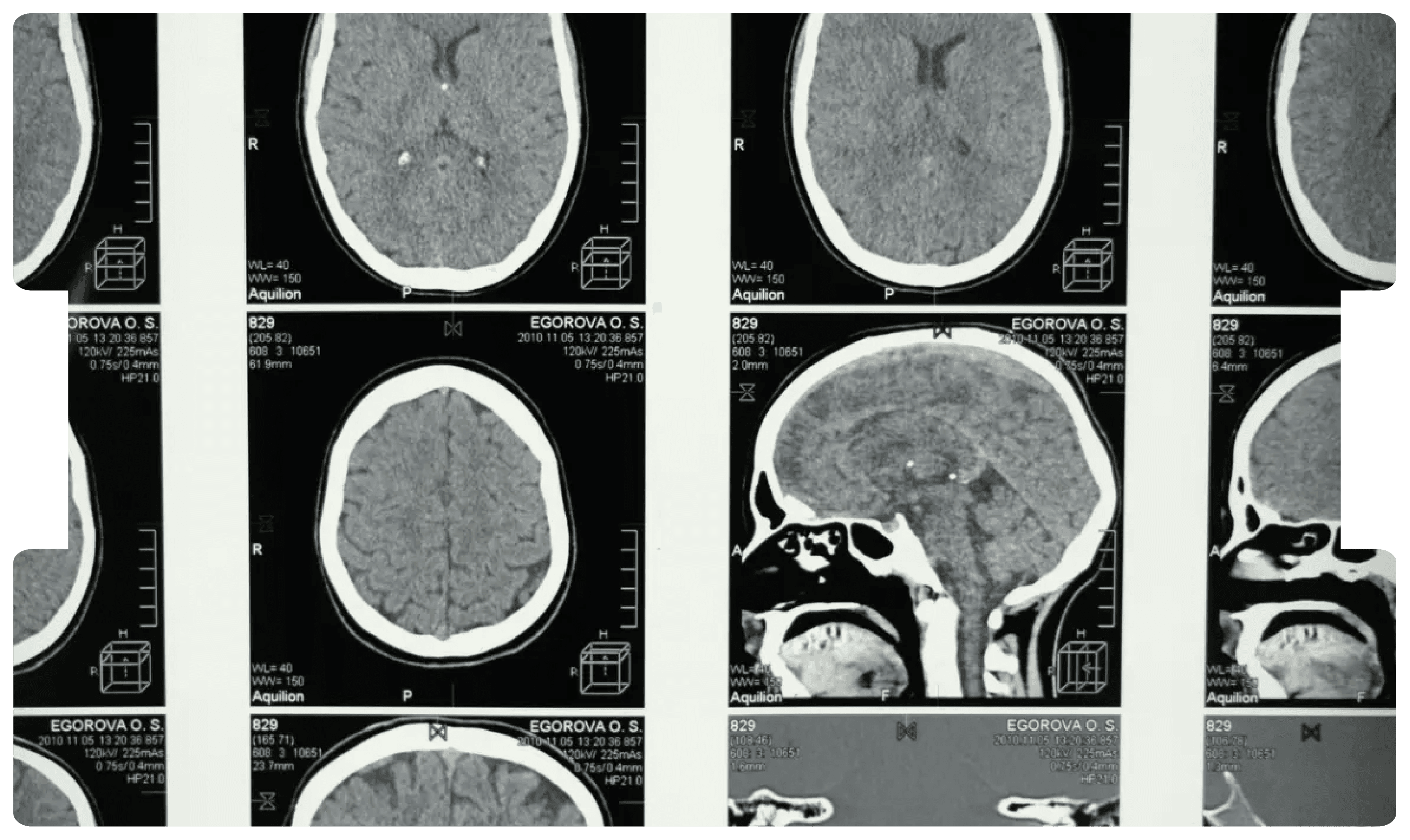 Brain CT scans displayed for analysis, highlighting the diagnostic and medico-legal complexities of distinguishing genuine neurological symptoms from malingering.