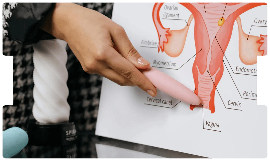 Medical professional using an anatomical diagram of the female reproductive system to explain ovarian cancer and its medico-legal relevance.