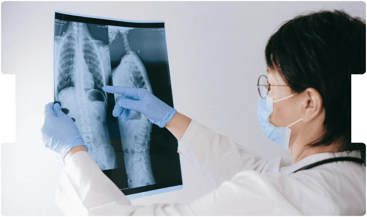 Doctor examining spinal X-rays, representing evaluation and treatment planning for paediatric spinal surgery.