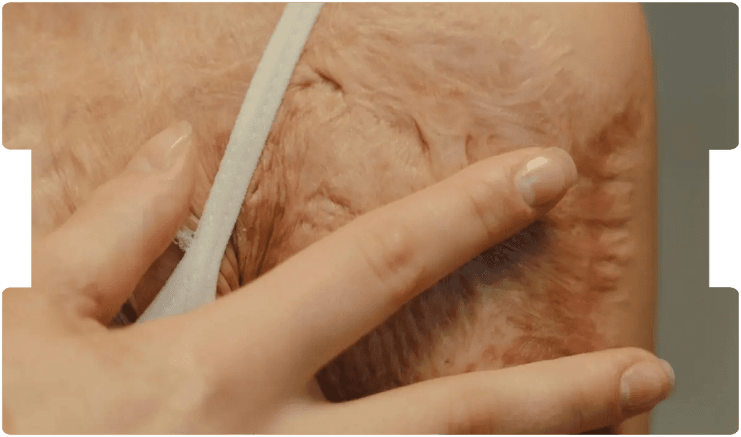 Close-up of a person’s healed scar on the shoulder, illustrating advances in modern scar management and rehabilitation techniques.