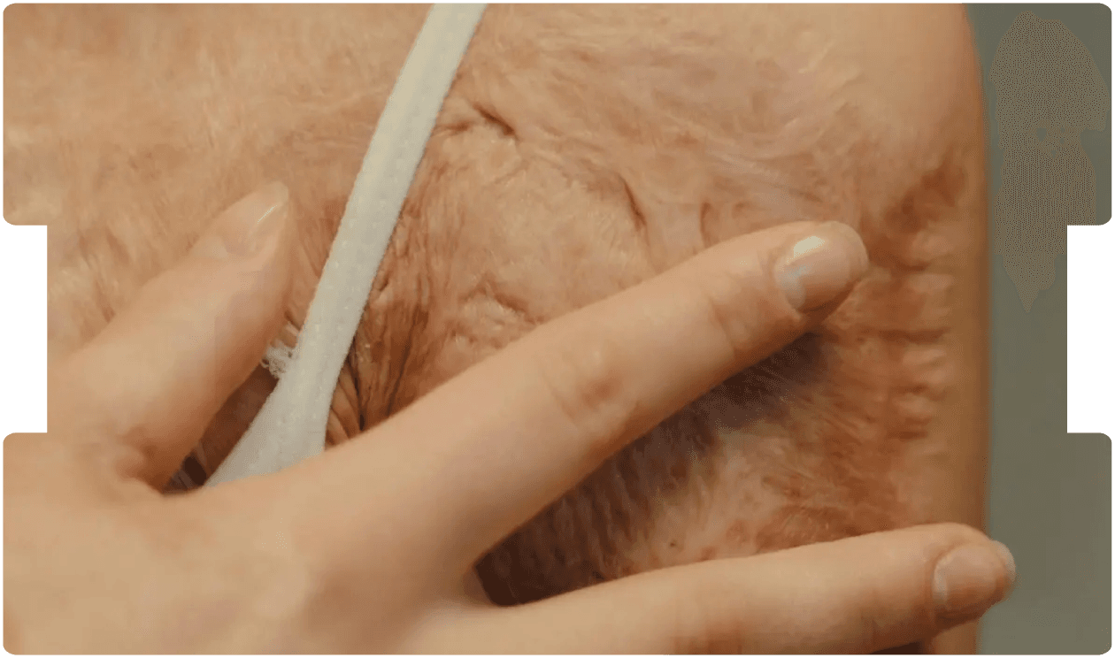 Close-up of a person’s healed scar on the shoulder, illustrating advances in modern scar management and rehabilitation techniques.