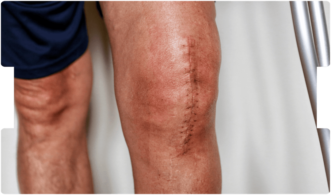 Healing knee incision with visible stitches and mild swelling, showing post-surgery recovery and scarring support for injury rehabilitation.
