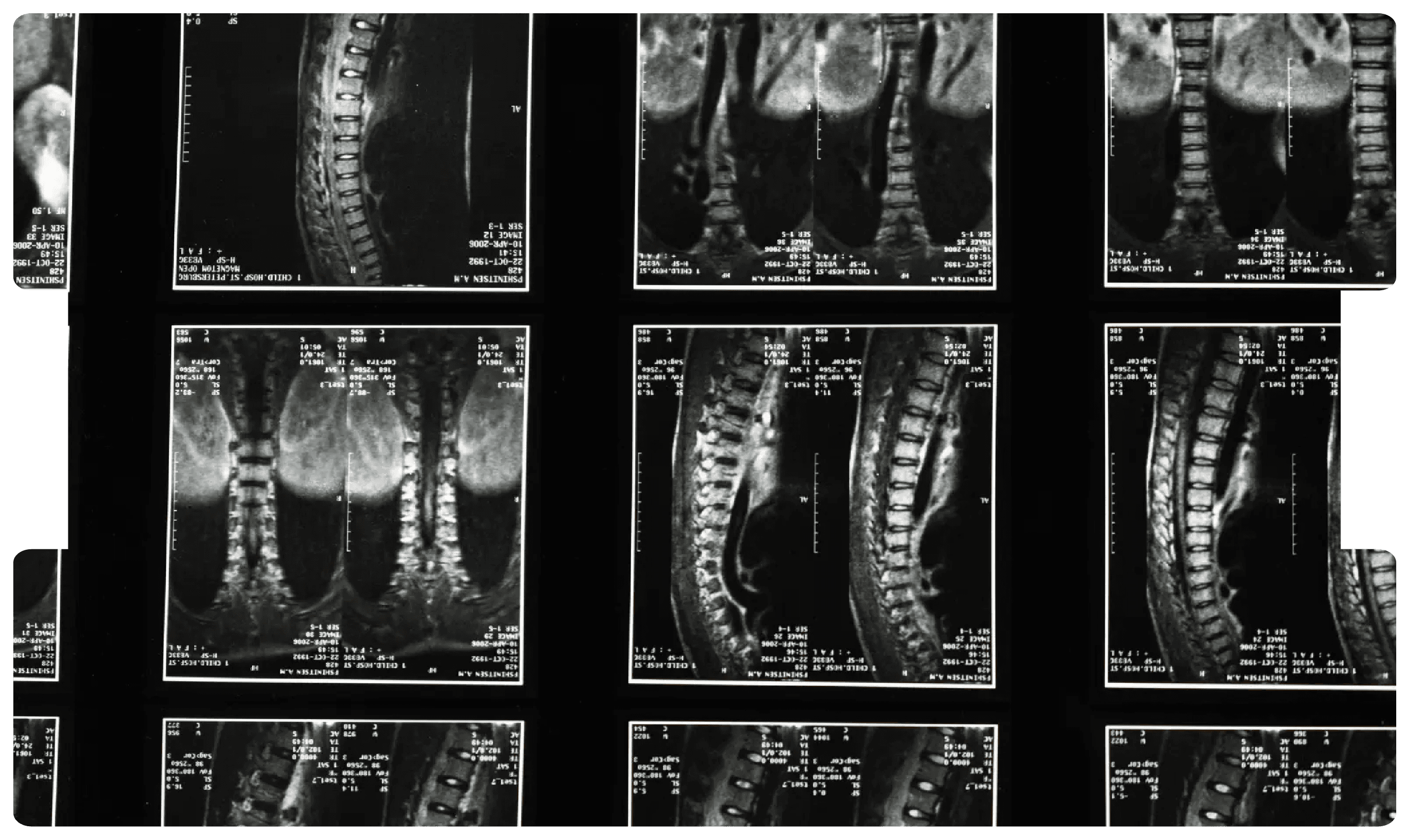 Series of spinal MRI scans showing curvature of the spine, illustrating key medical insights for solicitors handling scoliosis cases.