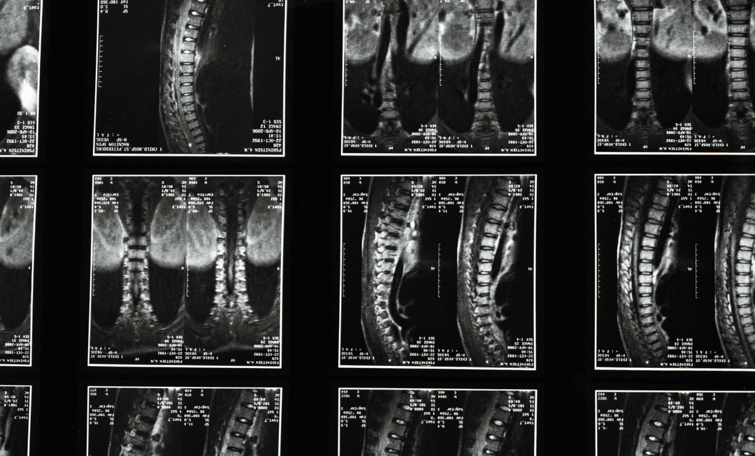 Series of spinal MRI scans showing curvature of the spine, illustrating key medical insights for solicitors handling scoliosis cases.