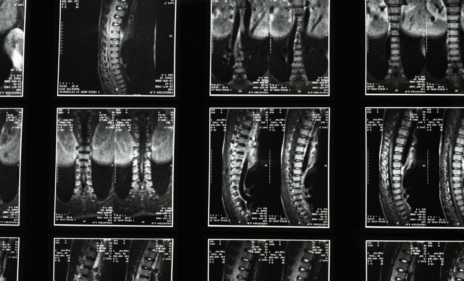 scoliosis-xray-spinal-inneg