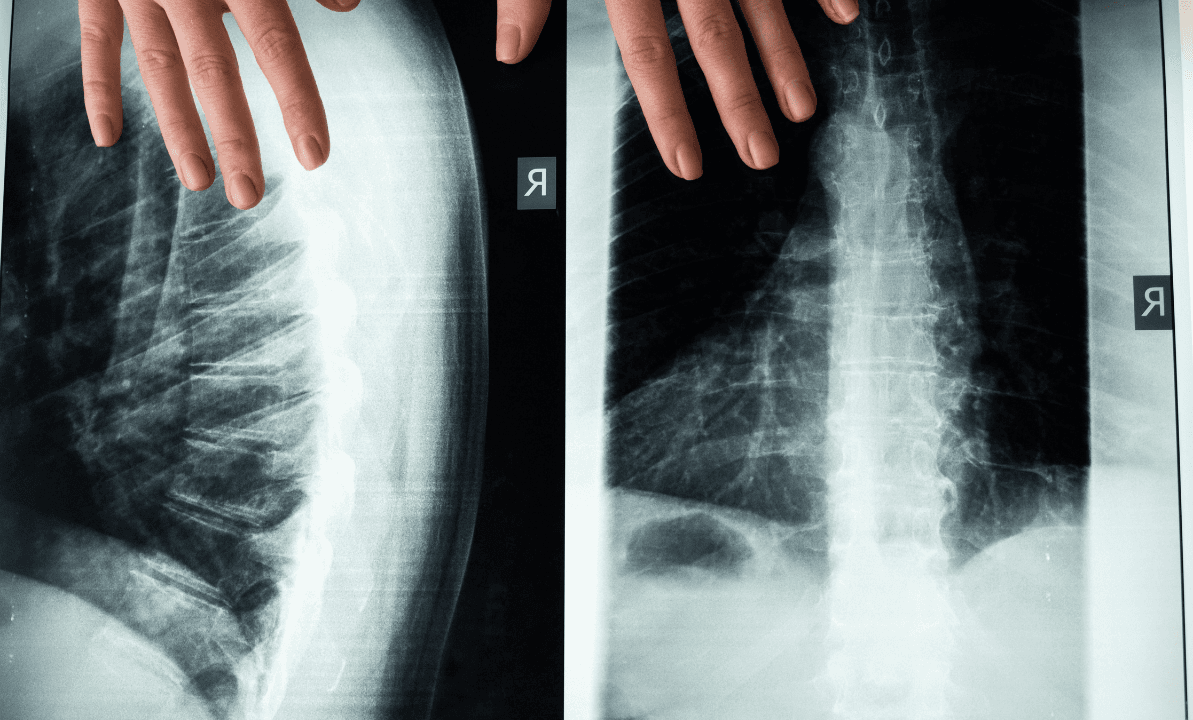 spinal-infection-diagnosis-treatment-medicolegal.png