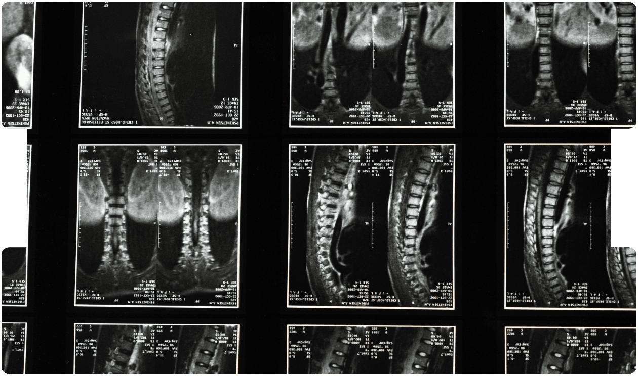 Detailed spinal MRI scans showing vertebrae and soft-tissue contrast, supporting precise diagnostic imaging and advanced neuroradiology review.