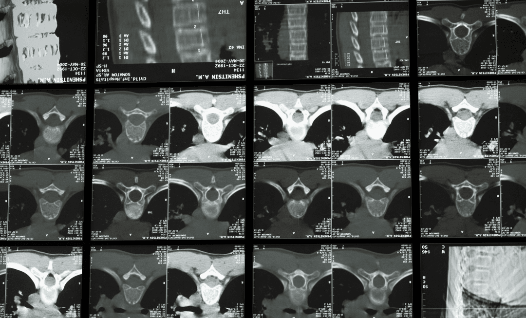 Series of spinal CT scans, underscoring the importance of in-person medical examinations for accurate spinal injury assessments in legal claims.