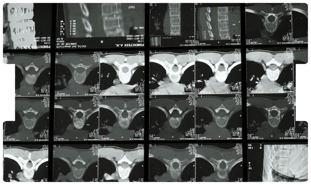Series of spinal CT scans, underscoring the importance of in-person medical examinations for accurate spinal injury assessments in legal claims.