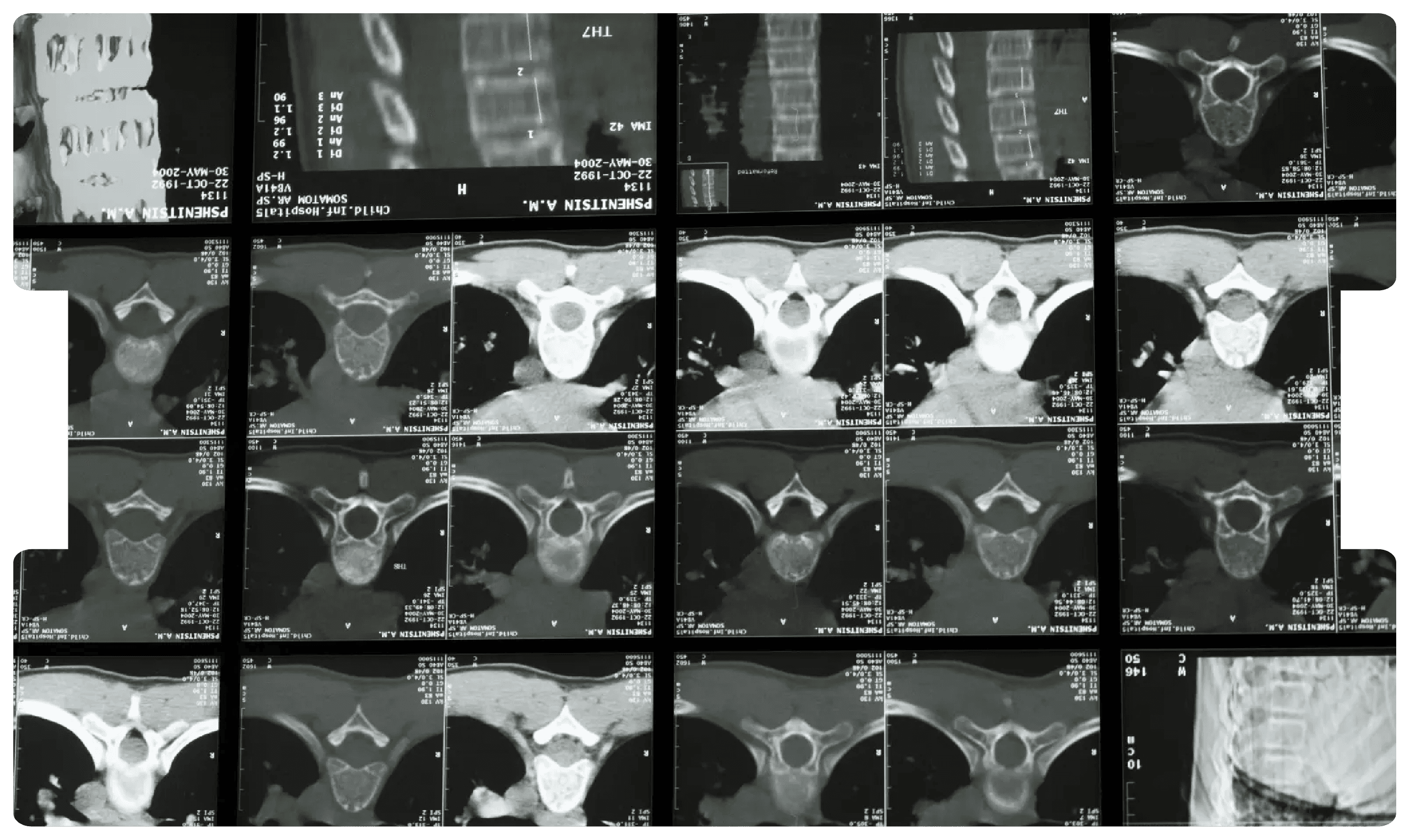 Series of spinal CT scans, underscoring the importance of in-person medical examinations for accurate spinal injury assessments in legal claims.
