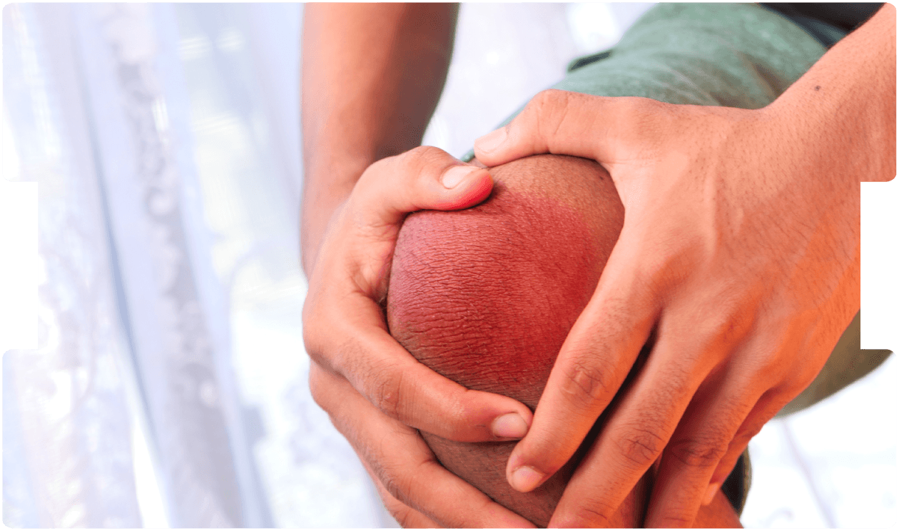Person holding a swollen, reddened knee, illustrating pain and inflammation from a growth plate injury.