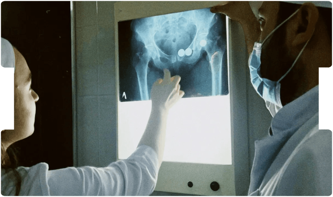 Medical professionals reviewing a hip X-ray, illustrating the clinical and legal implications of implant misplacement in personal injury cases.