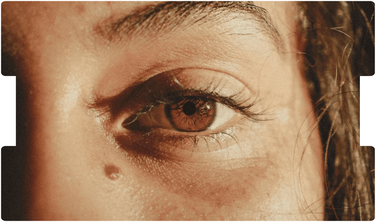 Close-up of a person’s eye and surrounding skin, illustrating vigilance in recognising melanoma signs and addressing related litigation issues.