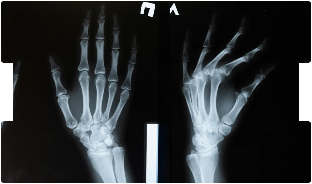 X-ray images of fractured hands, illustrating diagnostic challenges and medico-legal insights gained from nine years of missed fracture cases.