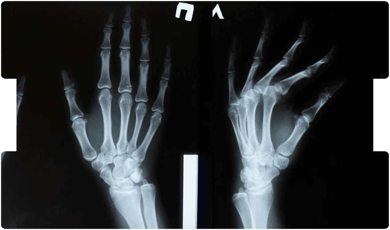 X-ray images of fractured hands, illustrating diagnostic challenges and medico-legal insights gained from nine years of missed fracture cases.