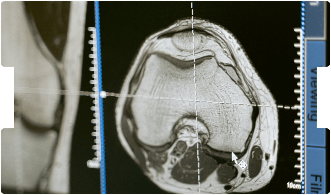 CT brain scan images showing signs consistent with mild traumatic brain injury.