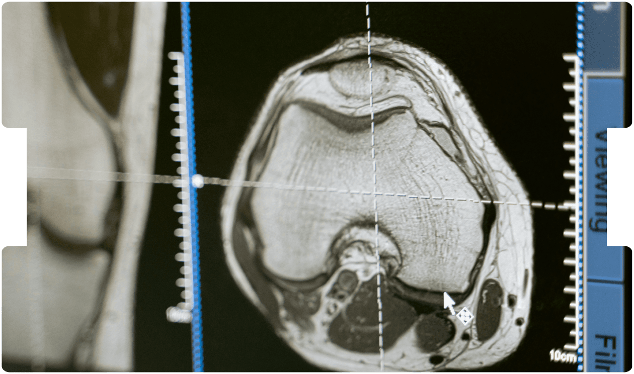 CT brain scan images showing signs consistent with mild traumatic brain injury.