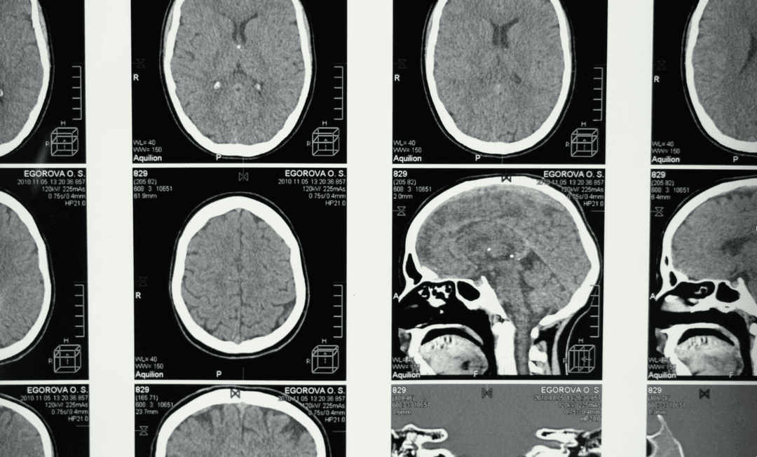 Brain CT scans displayed for analysis, highlighting the diagnostic and medico-legal complexities of distinguishing genuine neurological symptoms from malingering.