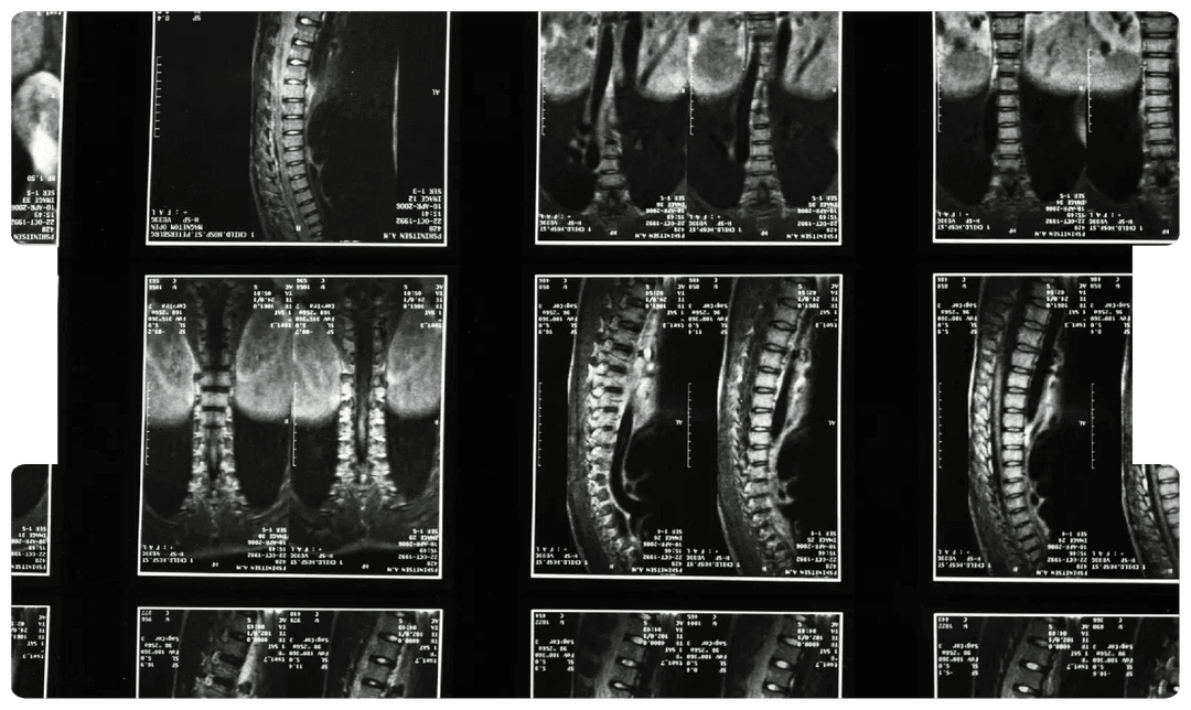 Series of spinal MRI scans showing curvature of the spine, illustrating key medical insights for solicitors handling scoliosis cases.