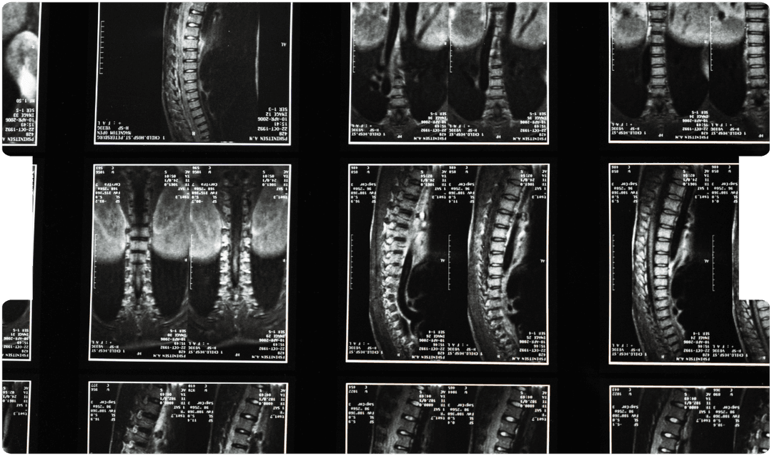 spinal-cord-compression-neurosurgery-expert-witness-inneg
