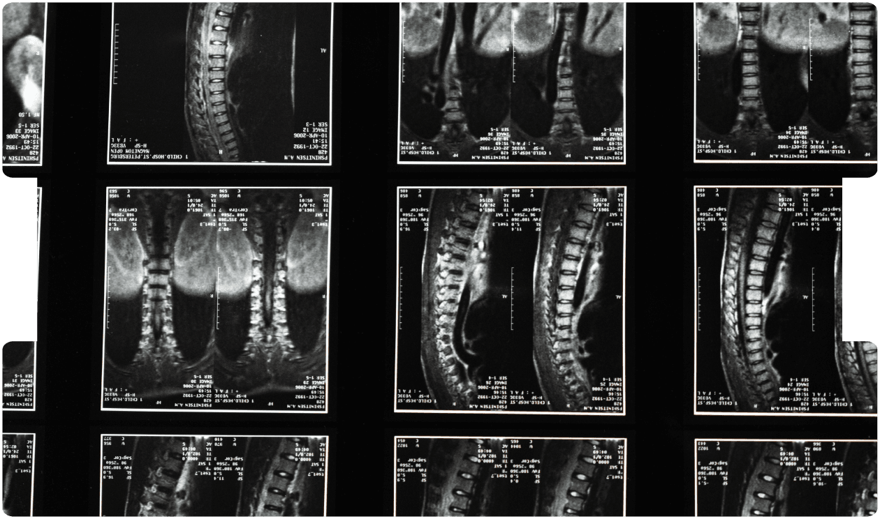 spinal-cord-compression-neurosurgery-expert-witness-inneg