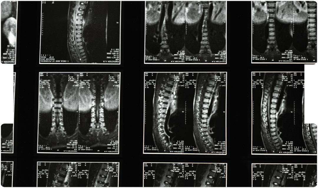 Detailed spinal MRI scans showing vertebrae and soft-tissue contrast, supporting precise diagnostic imaging and advanced neuroradiology review.